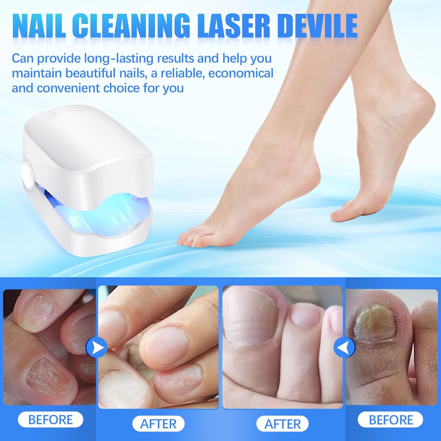 Rechargeable Nail Fungus Laser Anti-Fungal Device for Toenails, Hands Feet (Home Use)